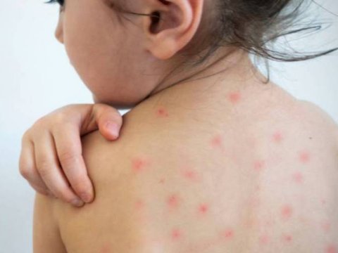 Ermənistanda qızılcaya yoluxanların SAYI