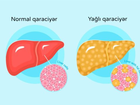 İnsanın çöhrəsi qaraciyərdəki xəstəliklərin əlamətlərini göstərir