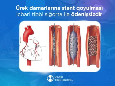 Ürək damarlarına stentin qoyulması pulsuzdur - İcbari tibbi sığorta