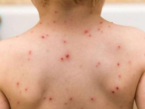 Ermənistanda qızılcaya yoluxanların sayı açıqlandı