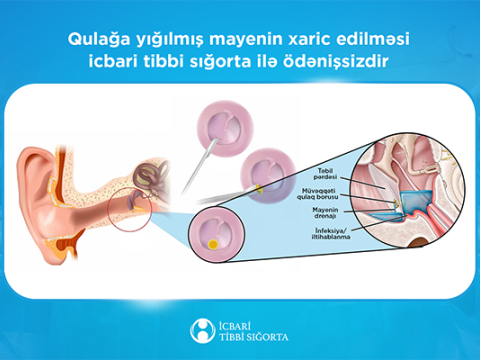 İcbari tibbi sığorta bu əməliyyatı da qarşılayır