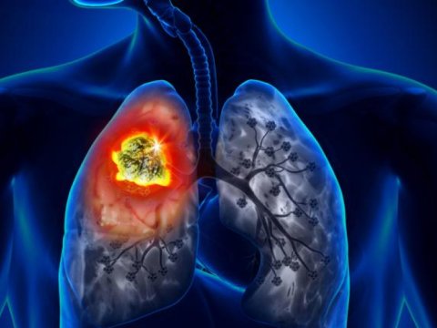 Ağciyər xərçəngi dünyada xərçəngdən ölümlərin beşdə birini təşkil edir