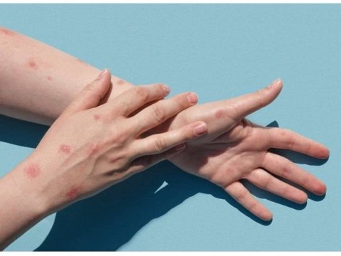 Meymunçiçəyi yayılır: Hansı regionlarda risk daha böyükdür?