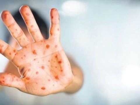 Meymunçiçəyi&nbsp;yayılır: Simptomları nədir və necə yoluxur...&nbsp;