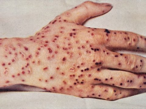 Meymunçiçəyi yayılır: Kimlərin yoluxmaq ehtimalı daha çoxdur?