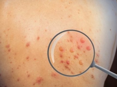 Azərbaycanda meymunçiçəyinə yoluxan var? - Rəsmi AÇIQLAMA