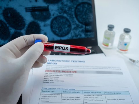 Britaniyada fövqəladə vəziyyət - Meymunçiçəyinə görə...