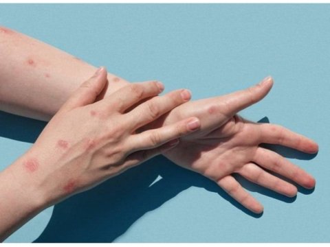 Türkiyədə meymunçiçəyi qeydə alınmayıb