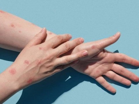 Azərbaycana meymunçiçəyinə qarşı dərmanlar GƏTİRİLDİ