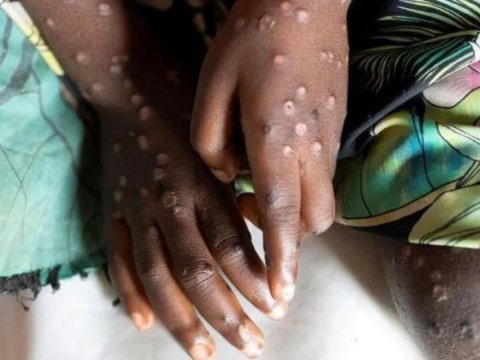 Meymunçiçəyi yeni COVID-19 deyil