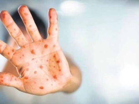 Ermənistanda meymunçiçəyi ilə bağlı QADAĞA