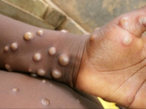 İspan qripi, COVID-19, indi də meymunçiçəyi və Nil qızdırması: Epidemiyaların səbəbi nədir?