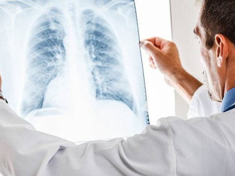 Ağciyər Xəstəlikləri Mərkəzi YARADILIR