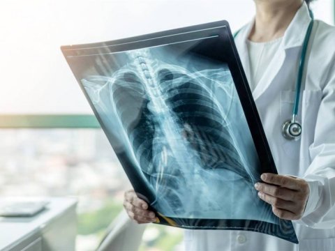 Həkim vərəmə meyilli olan şəxsləri AÇIQLADI