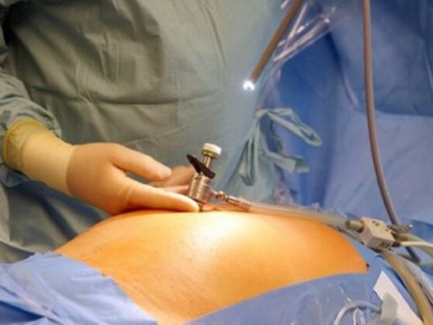 "Qansız əməliyyat" həyati təhlükə yaradır? - AÇIQLAMA