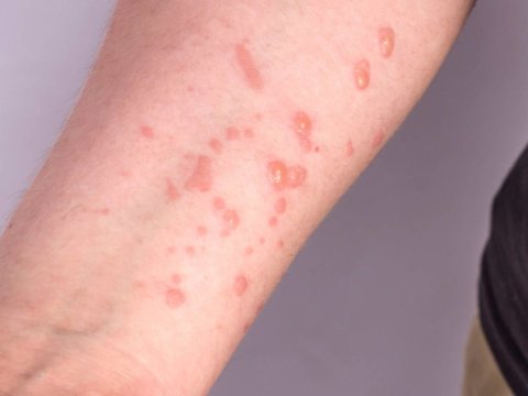 Azərbaycanda meymunçiçəyi ilə bağlı rəsmi AÇIQLAMA