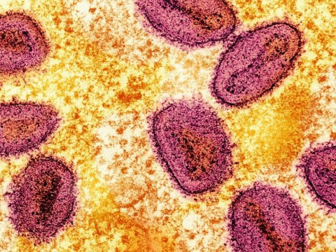 Britaniyada meymunçiçəyinin yeni ştamı aşkarlanıb