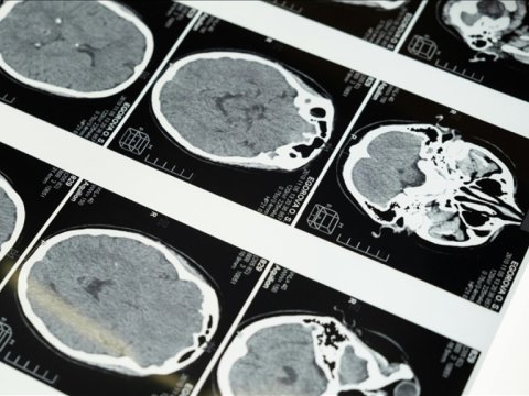 Nitq pozğunluğu insult əlaməti ola bilər