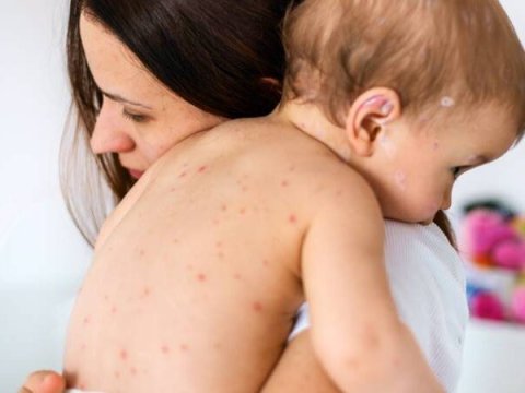 Ermənistanda qızılcaya yoluxma artıb