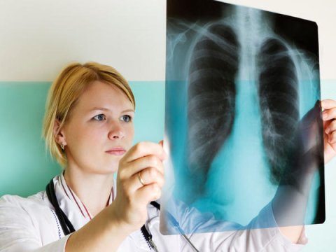 Dünyada vərəmə yoluxma artıb - ÜST&nbsp;&nbsp;