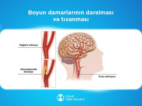 Bu müalicə də icbari tibbi sığortaya daxildir
