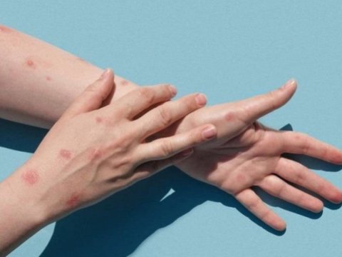 ABŞ-də meymunçiçəyi aşkarlandı