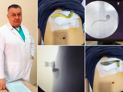 Bakıda qəribə hadisə: Azyaşlının qarnına qapı dəstəyi batdı - FOTO