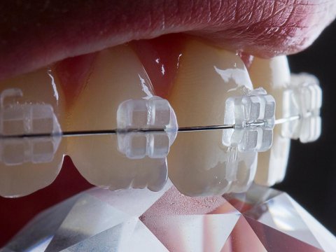 Breketi olanlara hərbi xidmətdən möhlət VERİLİR? - Rəsmi CAVAB