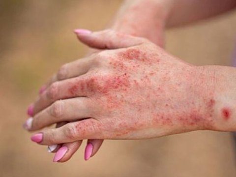 Azərbaycanda qızılcaya yoluxma halı kəskin AZALIB