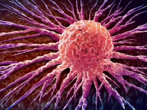 Süd vəzi xərçənginin yayılması irsidir - TƏDQİQAT