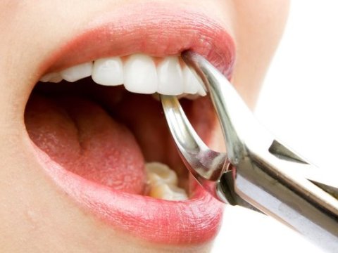 Stomatoloji kabinetlərdə diş çəkilməsi qadağan edilib? - Rəsmi CAVAB