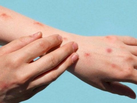 Səhiyyə Nazirliyi meymunçiçəyinin əsas əlamətlərini AÇIQLADI