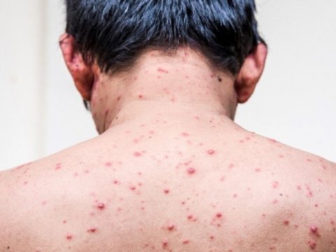 Meymunçiçəyi qorxulu epidemiya deyil - Azərbaycanlı infeksonist