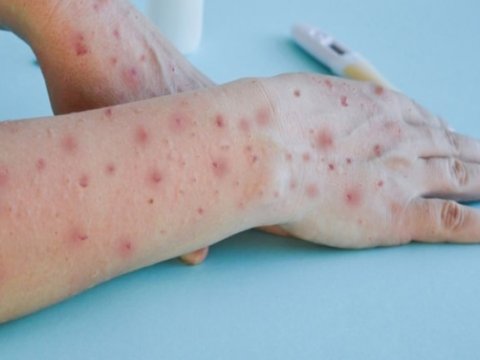 Meymunçiçəyinə yoluxmuş şəxsin son durumu AÇIQLANDI