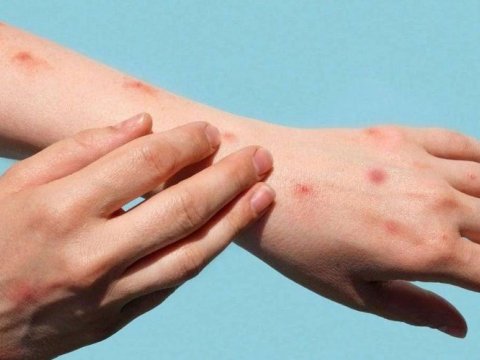 Meymunçiçəyinə&nbsp;yoluxan şəxs evə buraxıldı