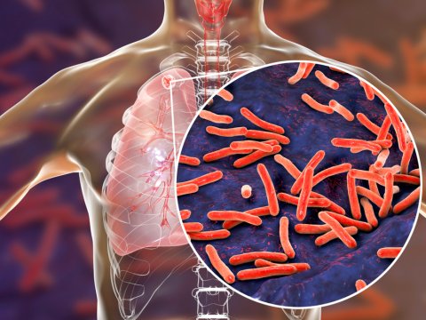 Ümumdünya vərəmlə mübarizə günü