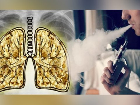 Elektron siqaret istifadəsi bu xəstəliyə səbəb olur