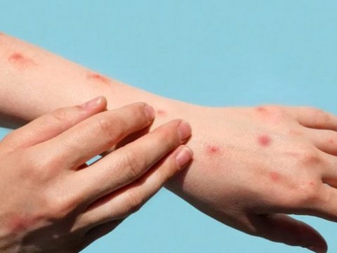 ABŞ-də qızılca: Yoluxanların sayı 700-ü keçdi