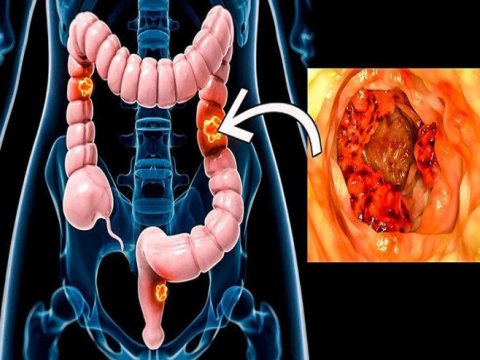 Bağırsaq xərçənginin geniş yayılmasının SƏBƏBİ