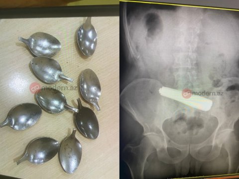 Bakıda bir nəfər 9 qaşıq uddu&nbsp;- ŞOK HADİSƏ - FOTOLAR