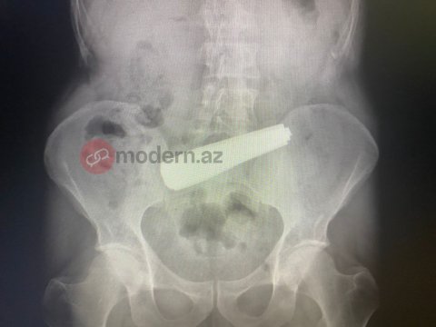 9 qaşıq udan kişi 4 saat əməliyyat edilibmiş - Həkimdən AÇIQLAMA