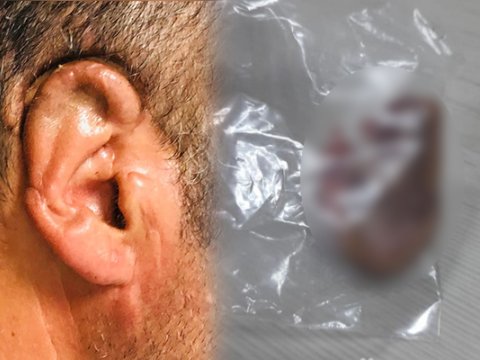 Bakıda kişinin qulağı qopdu: 34 saat sonra tikildi - FOTO