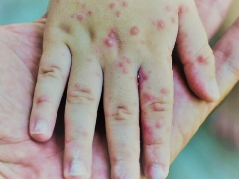 Azərbaycanda qızılcaya neçə nəfər yoluxub? - Rəsmi cavab