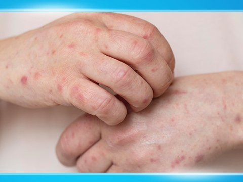 Qızılcanın müalicəsi pulsuz aparılır