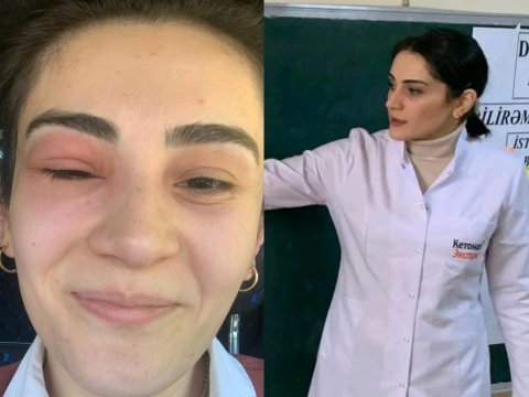 Gözünü arı sancan kimya müəllimi: “Tək gözlə 55 bal topladım”