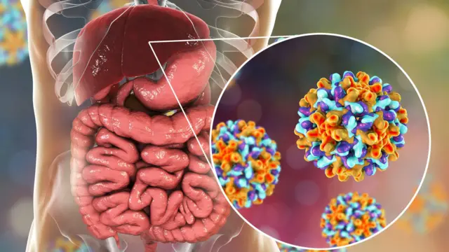 Dünyada 304 milyon insan hepatit B və ya C virusu ilə yaşayır