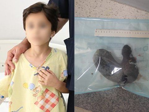 Mədəsindən saç çıxarılan azyaşlının anası:&nbsp;&ldquo;Tük axtarırdı ki, yesin&rdquo; - VİDEO