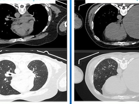 İki uzman həkim əməliyyat etdi, onkoloji xəstə sağaldı