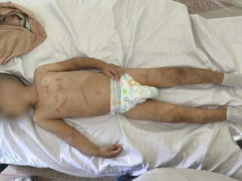 Valideynləri tərəfindən döyülən körpə süni nəfəs aparatına qoşuldu