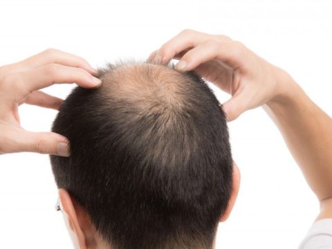 Saçı tökülənlərin ən çox olduğu bölgələr - Şəki, Zaqatala, Balakən